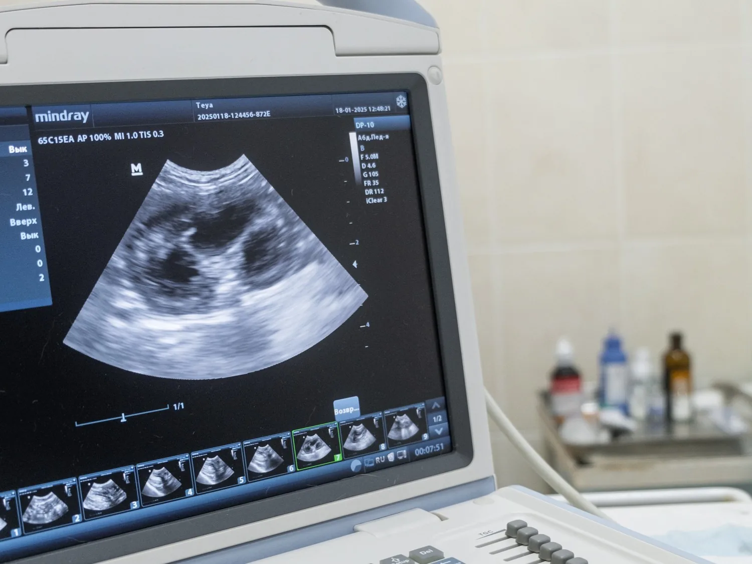 An in-house ultrasound machine displaying a live scan during a diagnostic work-up